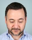 After Hair Transplant&nbsp;Front